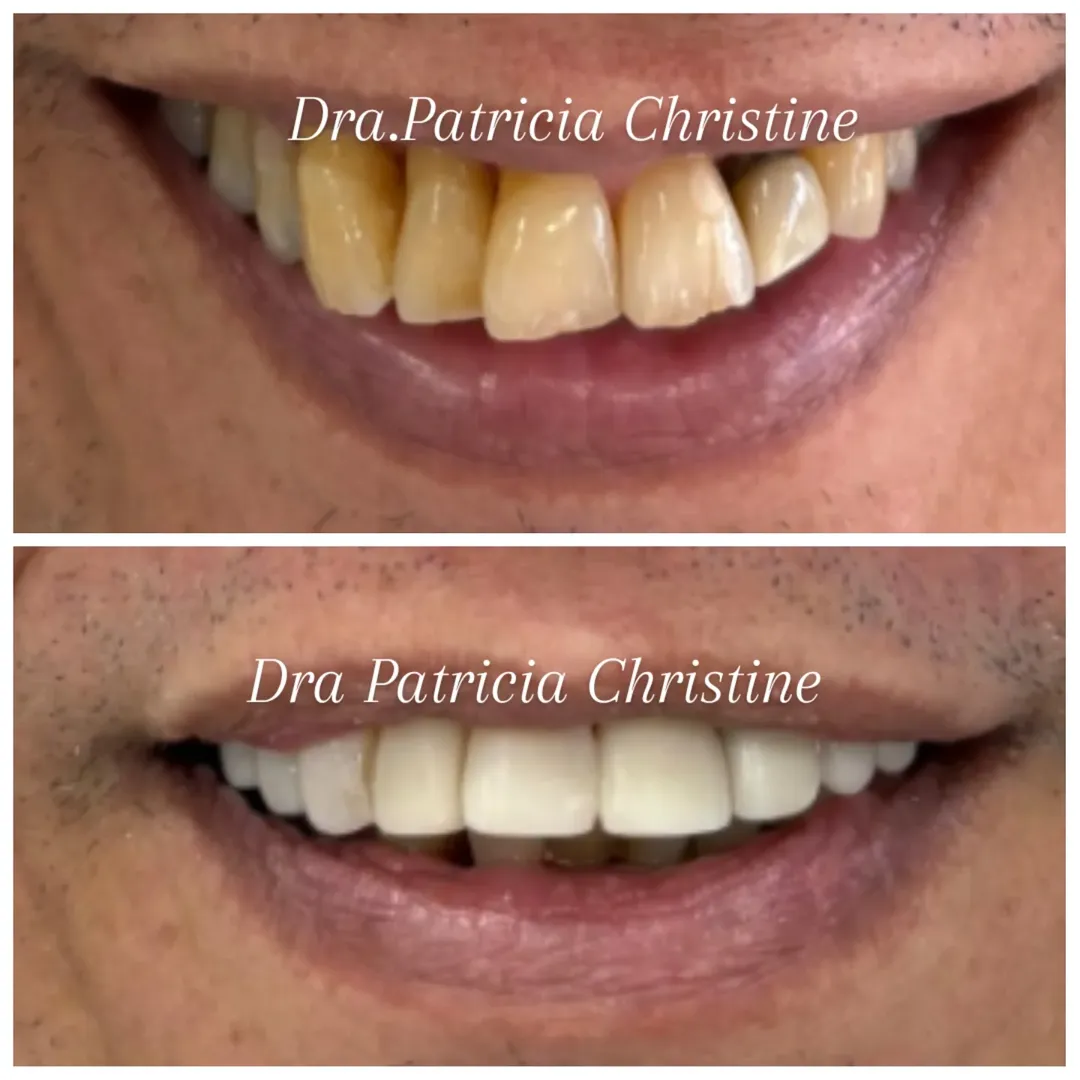 Tratamento Ortodôntico Invisível (antes e depois)